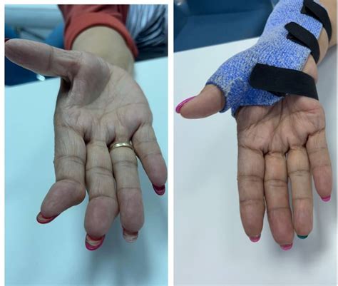 artrita reumatoidă a articulațiilor mâinilor